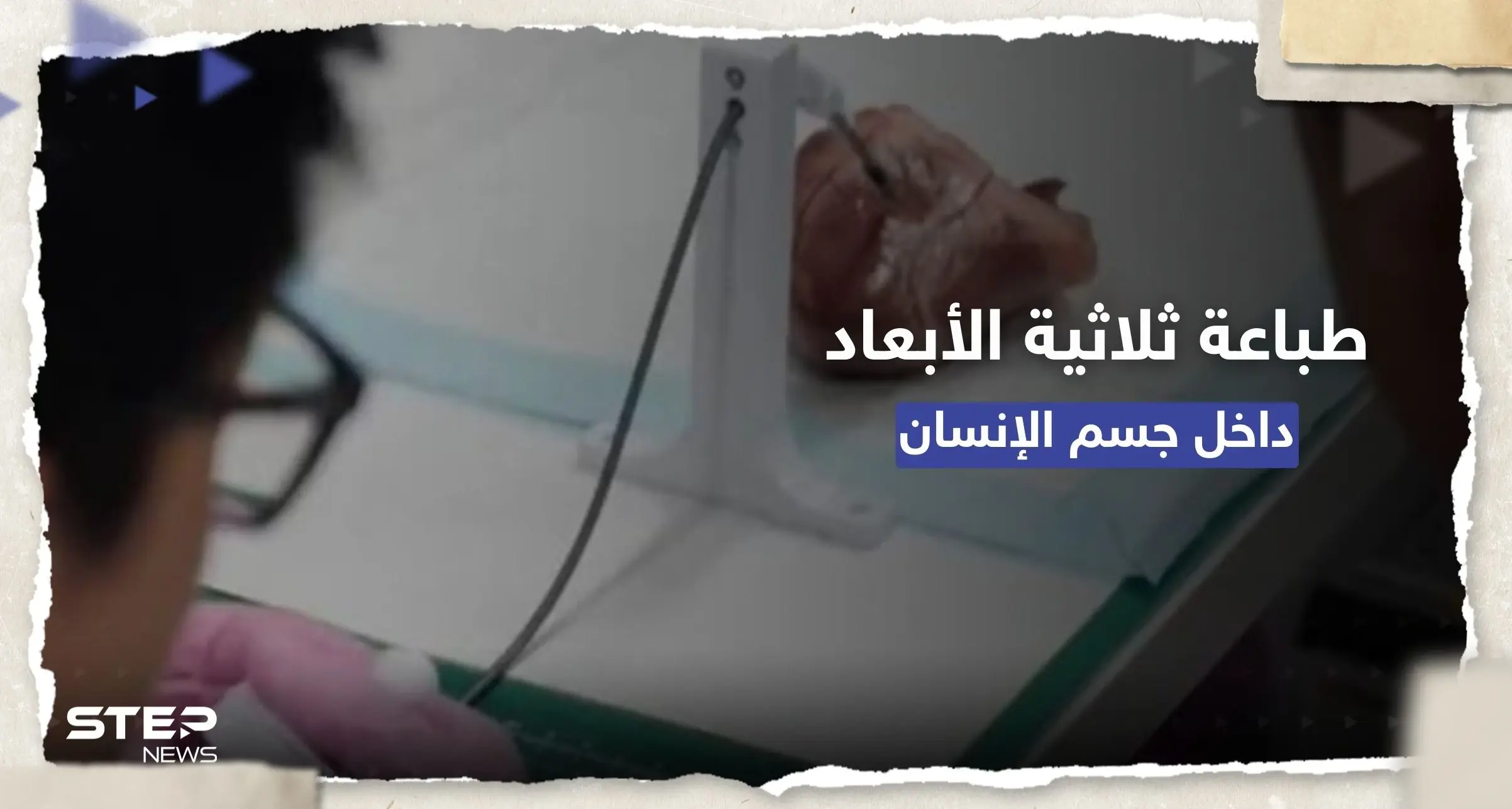 إنجاز علمي.. طباعة ثلاثية الأبعاد داخل جسم الإنسان: جسم الإنسان