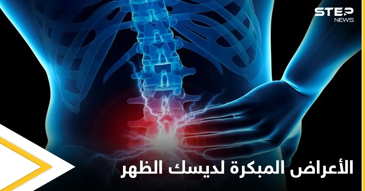 من أمراض العصر.. ديسك الظهر إليك أعراضه المبكرة وطرق علاجه: أعراض