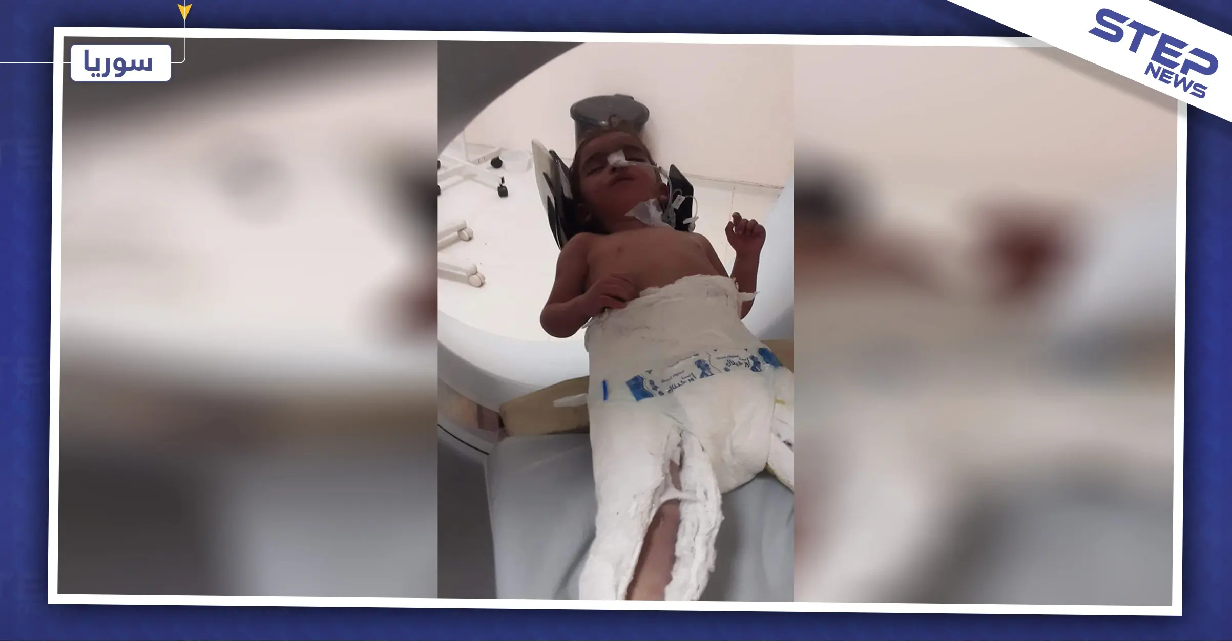 إهمال طفل مهجّر في مشفى الباب، ورفض تركيا إدخاله تتسبب بفقدانه أطرافه وبصره!!: مشفى