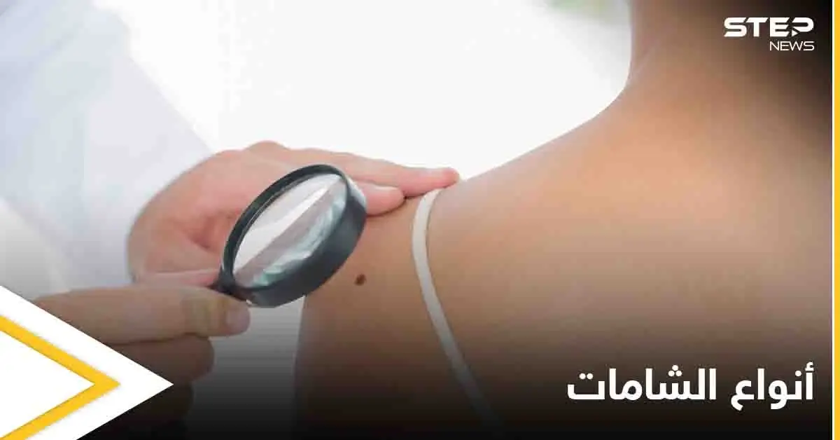 ماهي الشامة وهل لها علاقة بسرطان الجلد تعرف على أنواعها: سرطان الجلد