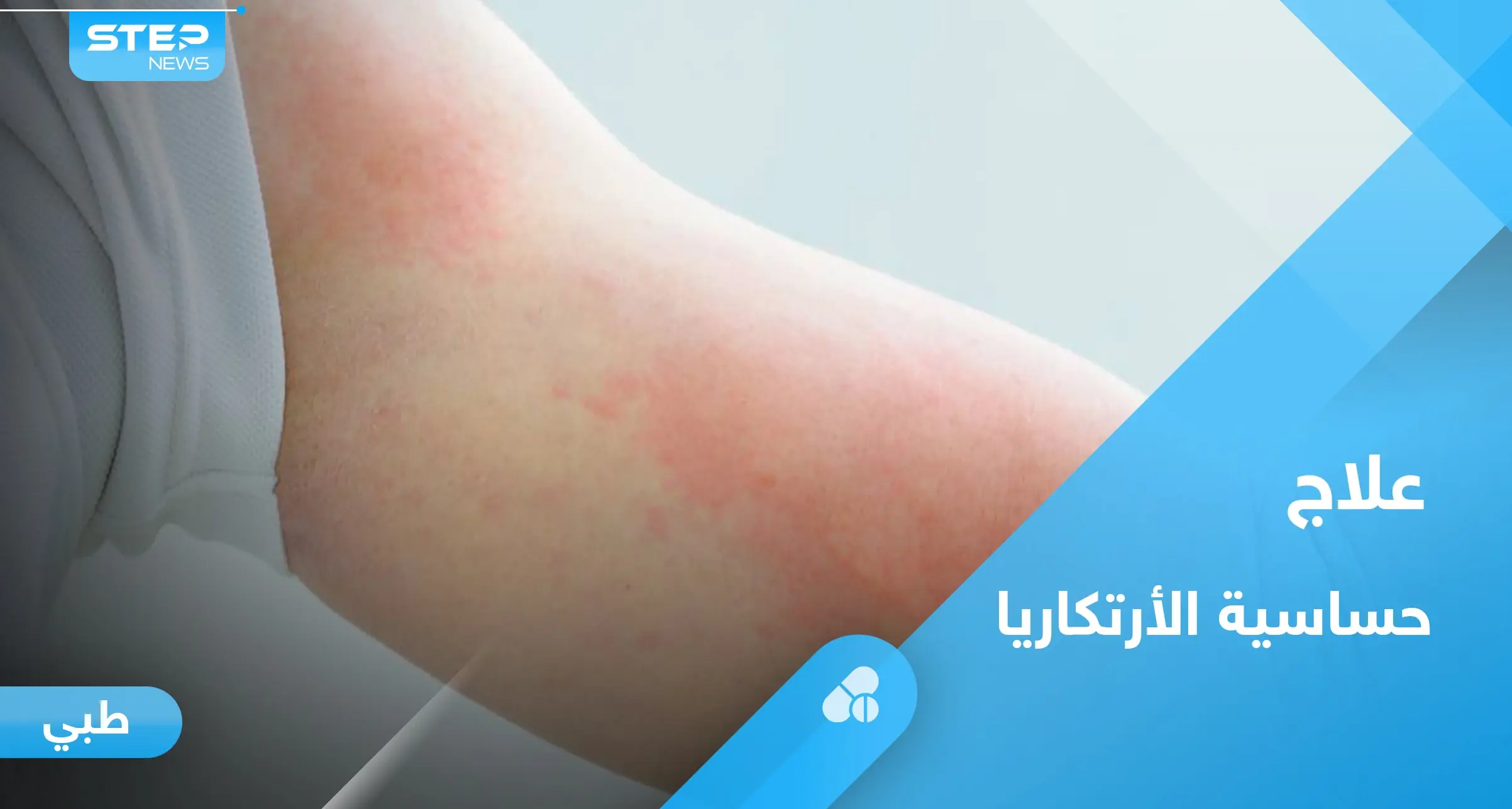 ما هي حساسية الأرتكاريا.. تعرف على أسبابها وأبرز طرق العلاج: حساسية الأرتكاريا