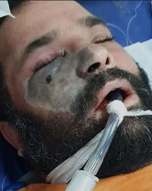 مصر تصدر بياناً بشأن تطورات الإصابة بـ الفطر الأسود.. ورئيس لجنة الصحة يناشد المواطنين: الفطر الأسود في مصر