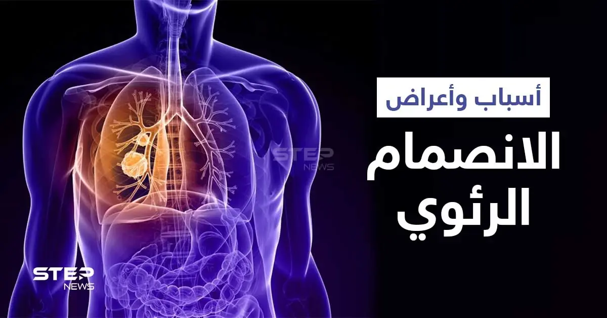 ماهو الانصمام الرئوي ومضاعفاته الخطيرة وعلاقته بالجلطة إليك أهم المعلومات: جلطة رئوية