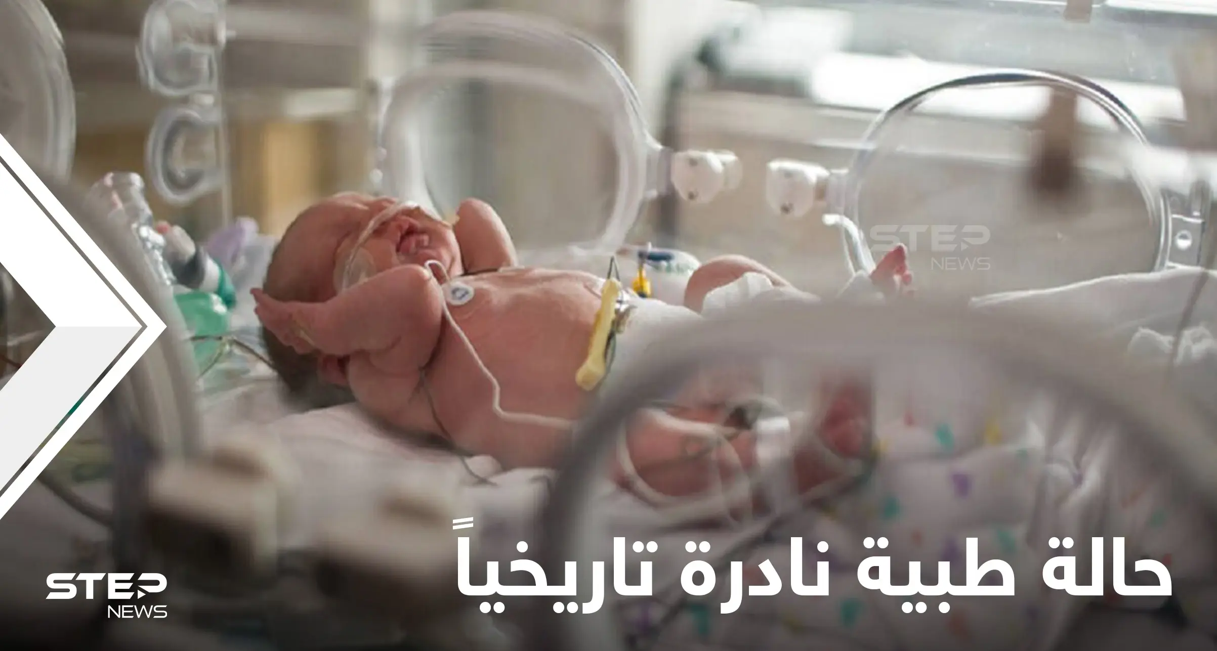 بحالة طبية نادرة للغاية.. ولادة طفل برازيلي بذيل بشري حقيقي مع كرة بنهايته (صور): طفل برازيلي بذيل